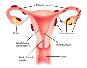 SOC 152C endometriosis pic